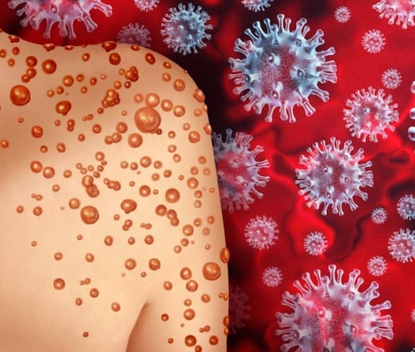 Maymun Çiçeği Virüsü: Yeni Bir Salgına Dönüşme Riski Var mı?